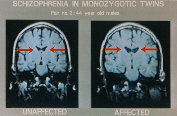 MRI Scans and Schizophrenia